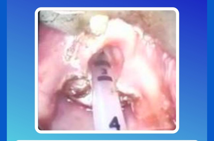 Epiglottoplasty