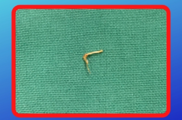 Fishbone in Throat - ASIAN ENT CARE