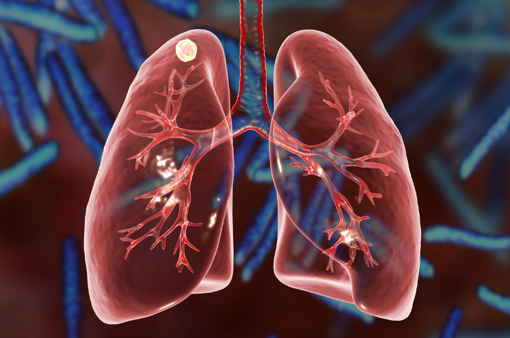 Foreign Body in Bronchus