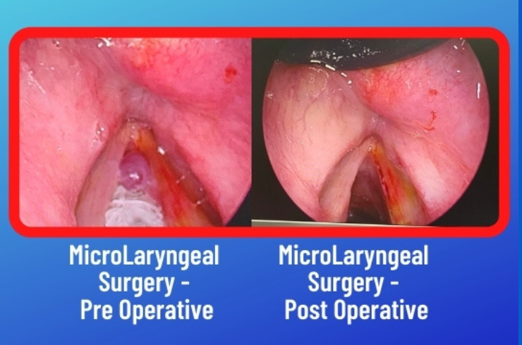 Micro Laryngeal Surgery