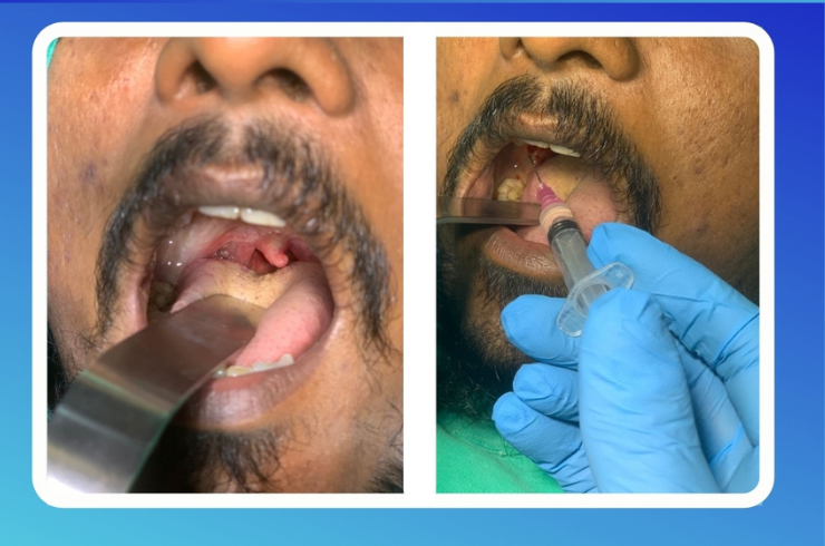 Oral Submucus Fibrosis