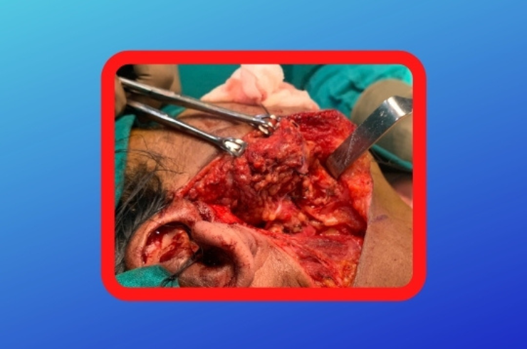 Parotid Gland Surgery