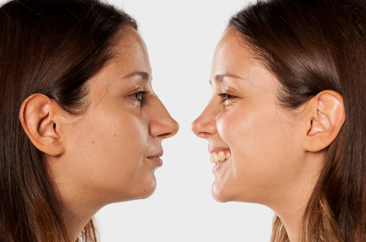 Rhinoplasty