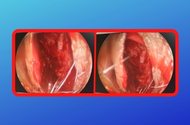 Septoplasty