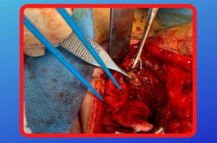 Thyroid Surgery